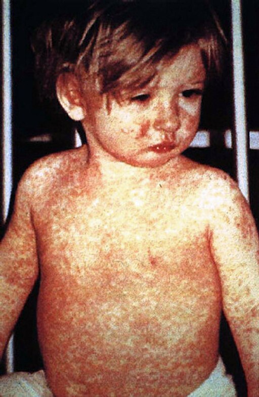 Child presenting classic symptom of measles rash.