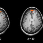 Listening for schizophrenia: How AI could help with early diagnosis