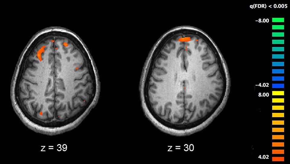 Image showing brain areas more active in controls than in schizophrenia patients during a working memory task during a fMRI study. Two brain slices are shown. 2010. Image from PLoS One. 2010 Aug 11;5(8):e12068. An event-related FMRI study of phonological verbal working memory in schizophrenia.doi:10.1371/journal.pone.0012068.g002